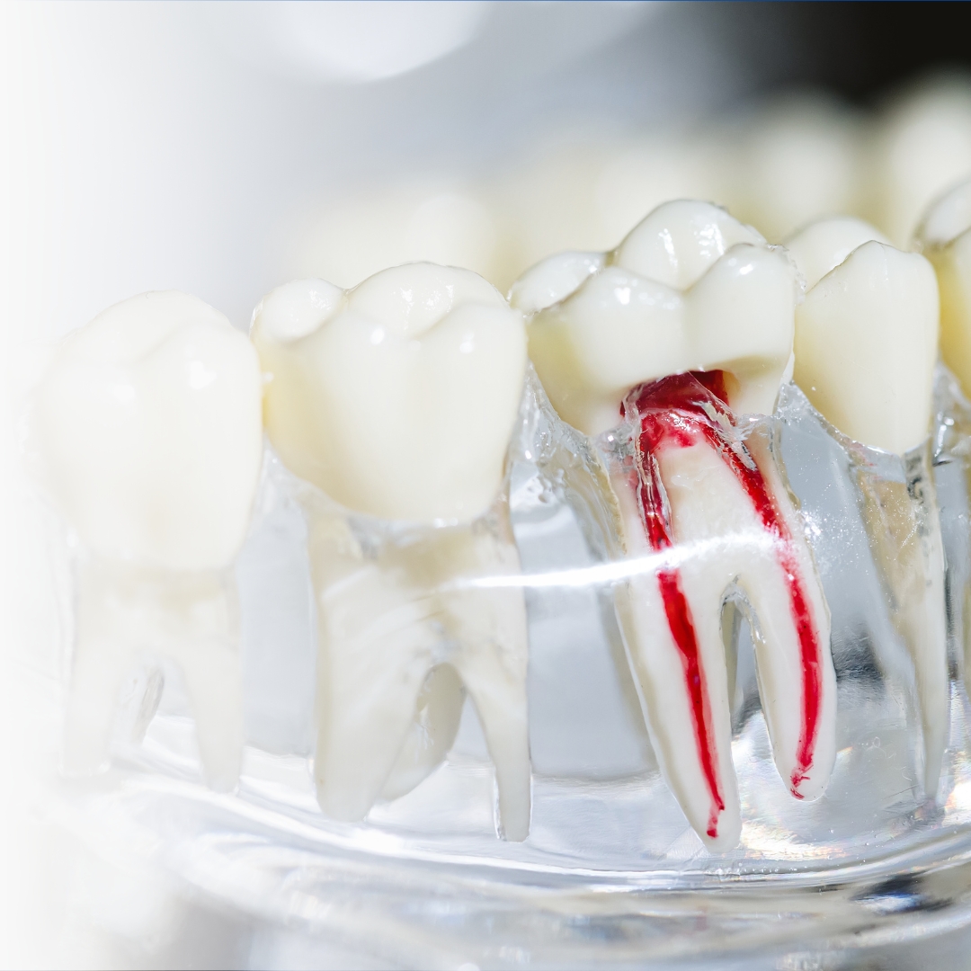 root canal therapy in Midtown Manhattan