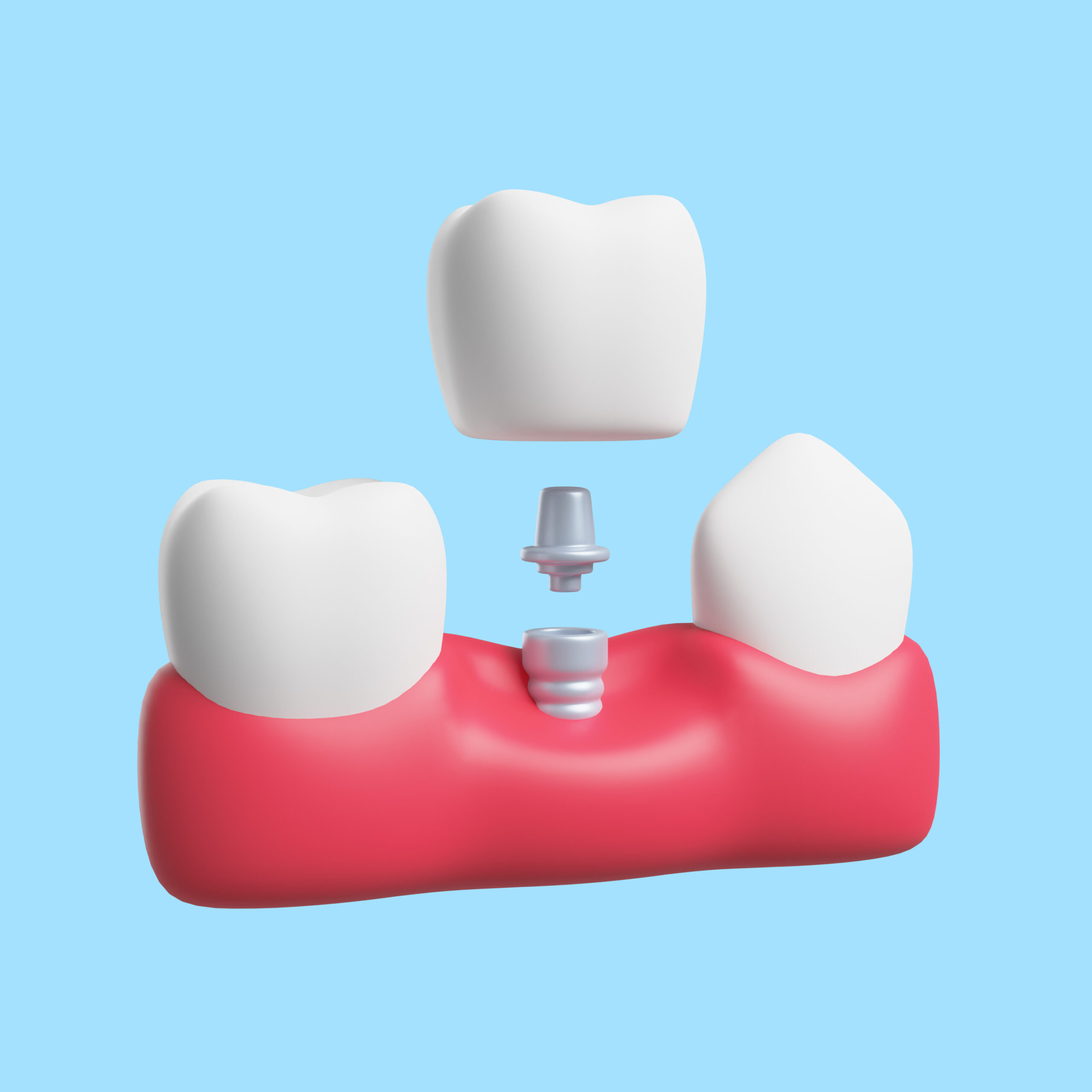 Dental Implants Anatomy Closeup Model