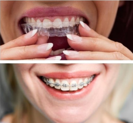 Split-screen comparison of a professional woman with ceramic braces and a woman holding an Invisalign aligner