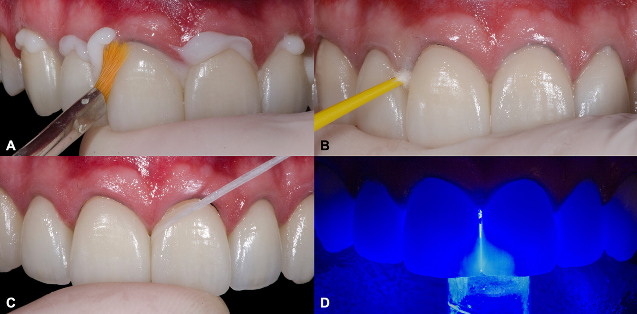 Porcelain veneers cementation procedure showing excess cement removal with brush, microbrush, dental floss, and light curing during a teeth whitening vs veneers treatment comparison.