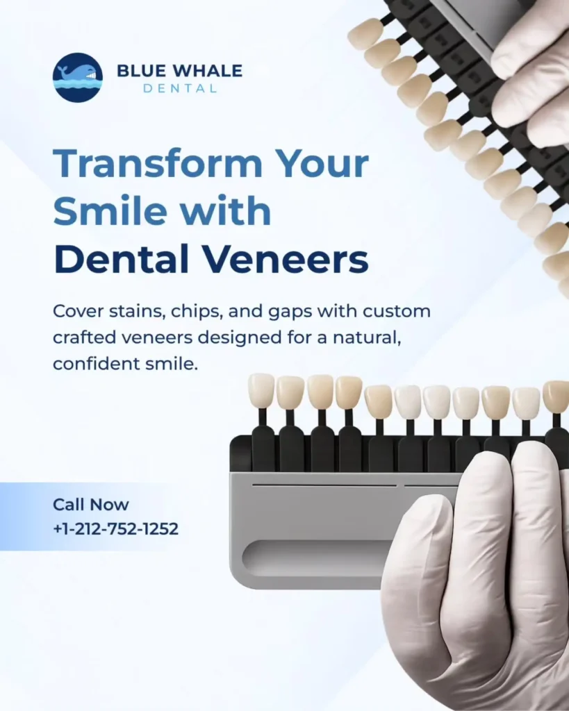 Dental veneers shade guide and custom veneer samples used to plan a natural-looking smile transformation.