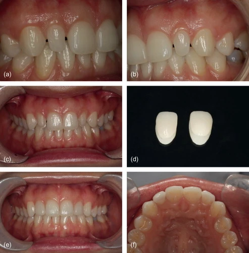 How long do veneers last? Clinical before and after images showing dental veneer treatment and final smile results.